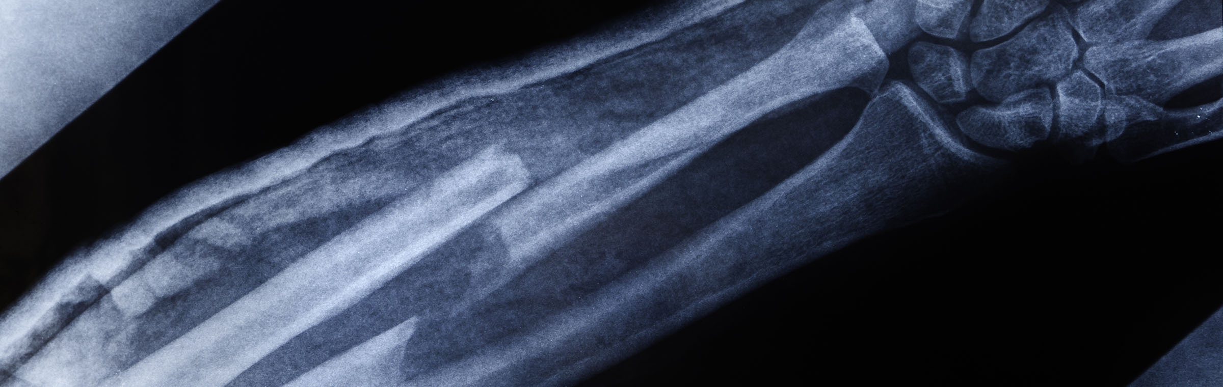 x-ray of a broken arm